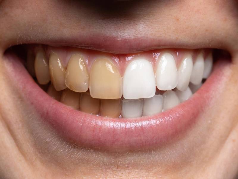 بررسی تفاوت خمیر دندان های میسویک